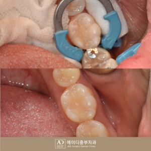 양산전악임플란트