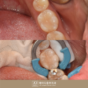 양산전악임플란트