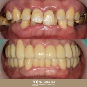 양산전체임플란트