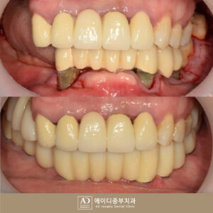 양산전체임플란트