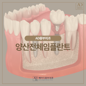 양산전체임플란트