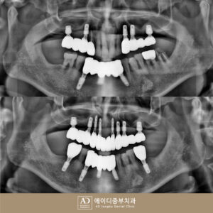 부산북구수면임플란트